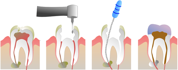 root-canal-process