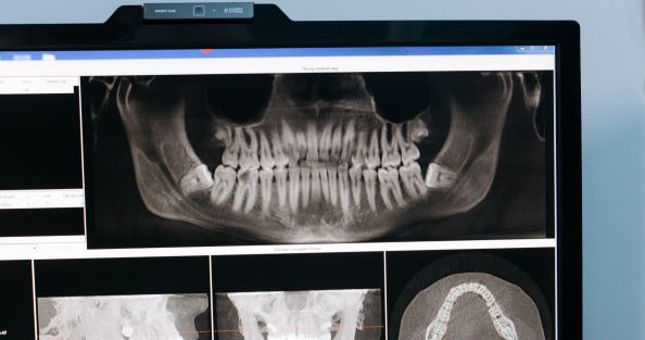 Dental X-ray on computer screen.