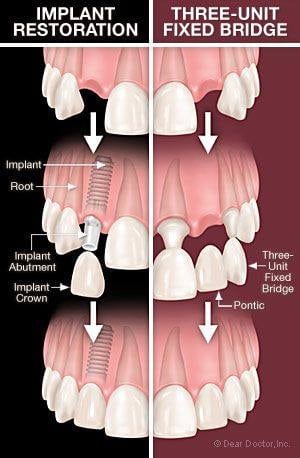 Implant Restoration