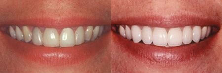 dental veneers before/after