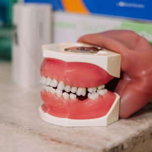 Dental model showing misaligned bite and tooth crowding