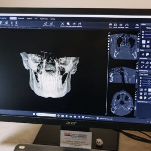 3D CBCT dental scan showing detailed jaw and tooth structure on a computer screen