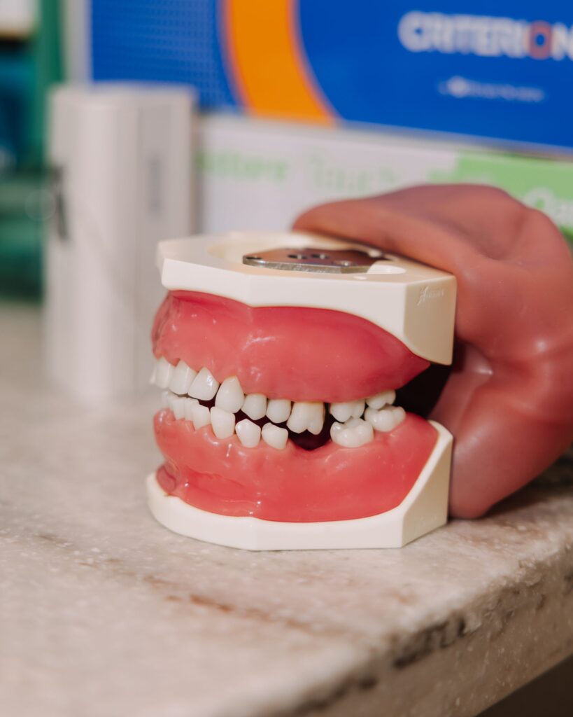 Dental model used to explain how a sports mouthguard protects the teeth and jaw